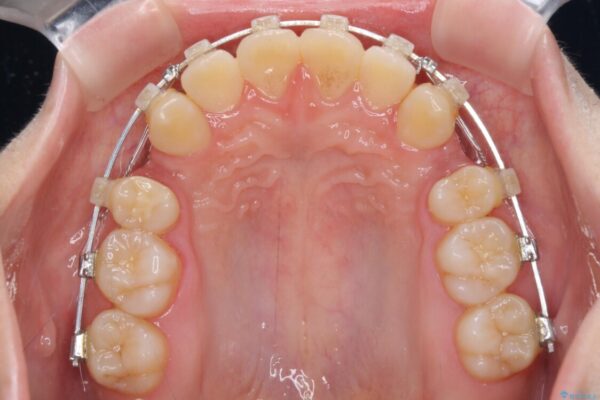 上下の出っ歯を治したい　ワイヤー装置による抜歯矯正 治療途中画像