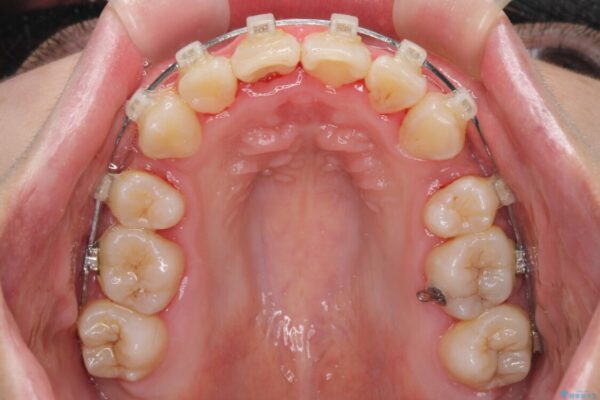 骨格的なズレをカムフラージュ　抜歯矯正で咬み合わせを改善 治療途中画像