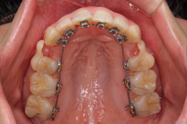 Eラインを改善したい　ハーフリンガルによる抜歯矯正 治療途中画像