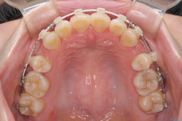 出っ歯を改善　目立たないワイヤー装置での抜歯矯正 治療途中画像