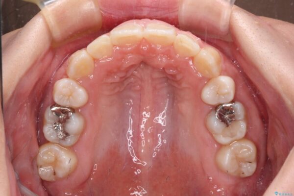 著しい八重歯を短期間で改善　ワイヤー装置による抜歯矯正 治療後画像