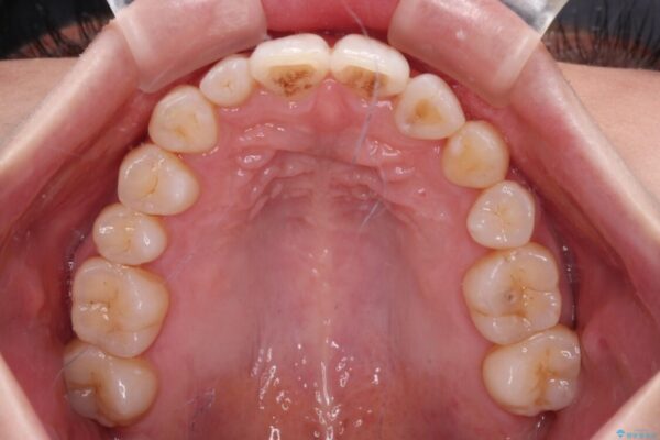 補助装置を併用したインビザラインでの八重歯の抜歯矯正 治療後画像