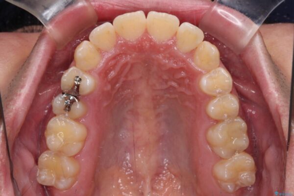 非抜歯ワイヤー装置による、短期間での矯正治療 治療後画像