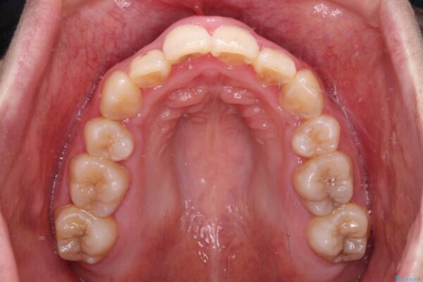 骨格的なズレをカムフラージュ　抜歯矯正で咬み合わせを改善 治療後画像