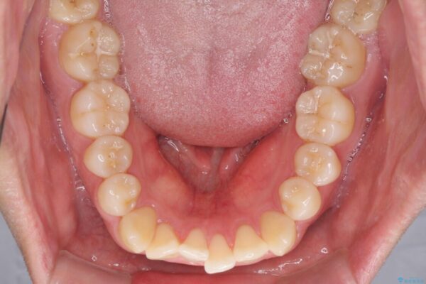 インビザラインで奥歯の咬み合わせと前歯のデコボコを改善 治療前画像