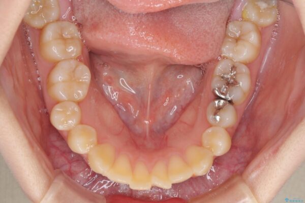上下の出っ歯を治したい　ワイヤー装置による抜歯矯正 治療前画像