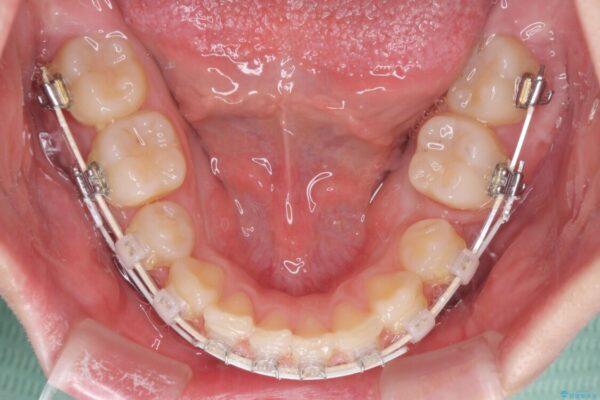 著しい八重歯を短期間で改善　ワイヤー装置による抜歯矯正 治療途中画像