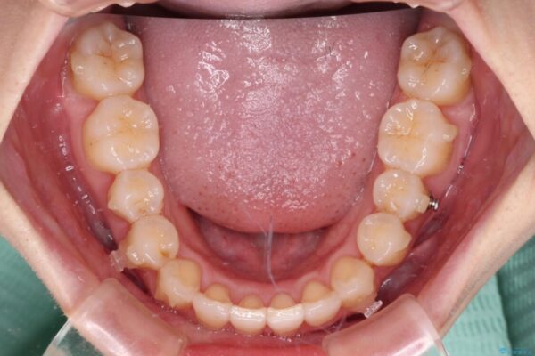 補助装置を併用したインビザラインでの八重歯の抜歯矯正 治療途中画像