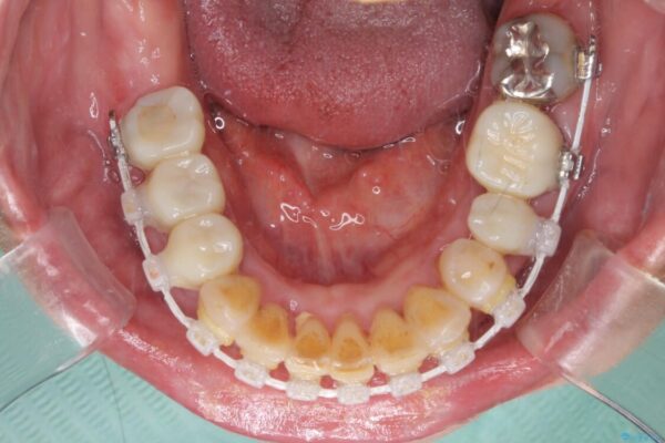銀歯や入れ歯で汚い歯をきれいにしたい　総合歯科治療 治療途中画像