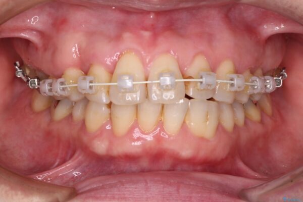 八重歯と形の悪い前歯　矯正治療とセラミック治療 治療途中画像