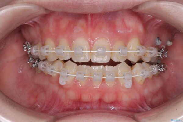 八重歯と前歯の欠損と骨格のズレ　目立たないワイヤー矯正 治療途中画像