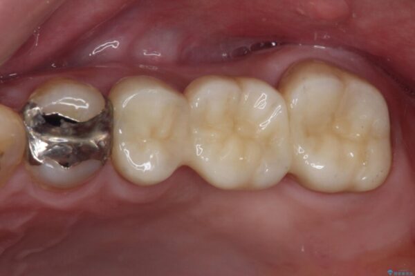 欠損と痛み　奥歯のむし歯治療 アフター