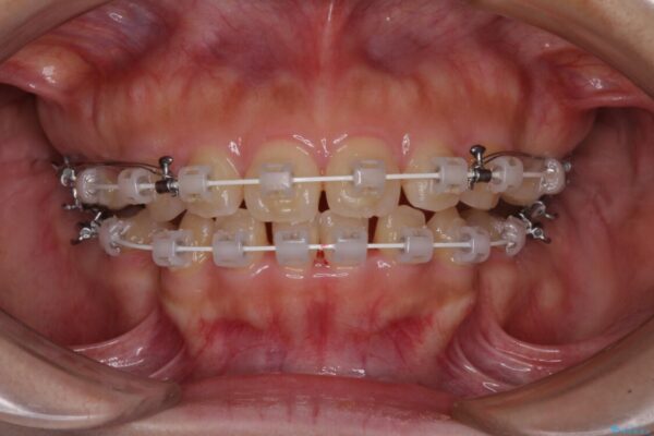 口元を引っ込めたい　目立たないワイヤー装置での抜歯矯正 治療途中画像