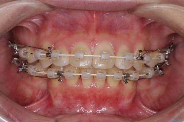 出っ歯を改善　目立たないワイヤー装置での抜歯矯正 治療途中画像