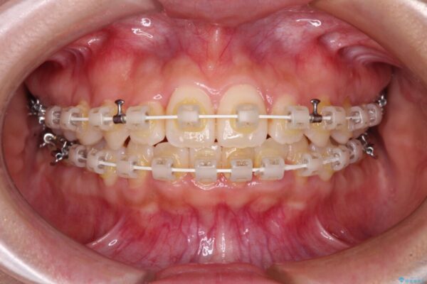 前歯のクロスバイト　目立たないワイヤー装置で速やかに矯正治療 治療途中画像