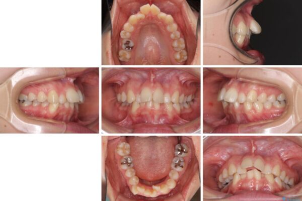 デコボコで飛び出した前歯　ワイヤー装置による抜歯矯正 治療前画像