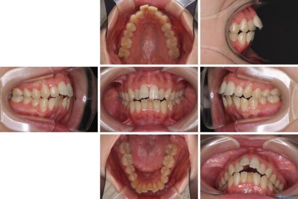 Eラインを改善したい　ハーフリンガルによる抜歯矯正 治療前画像