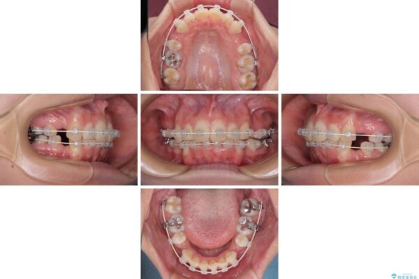 デコボコで飛び出した前歯　ワイヤー装置による抜歯矯正 治療途中画像