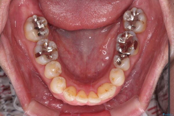 八重歯と形の悪い前歯　矯正治療とセラミック治療 治療後画像