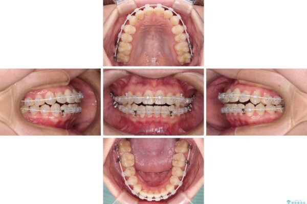ワイヤー矯正で楽して治療　前歯のデコボコを短期間で改善 治療途中画像