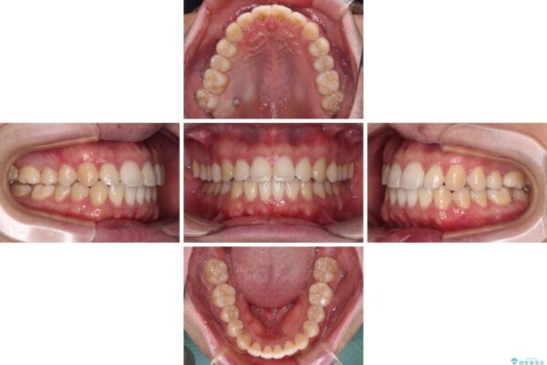 インビザラインで奥歯の咬み合わせと前歯のデコボコを改善 治療途中画像