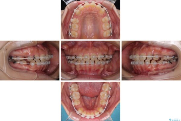 口元を引っ込めたい　目立たないワイヤー装置での抜歯矯正 治療途中画像