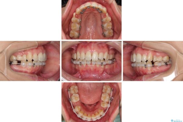 Eラインを改善したい　ハーフリンガルによる抜歯矯正 治療途中画像