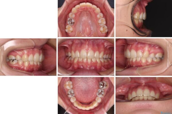 デコボコで飛び出した前歯　ワイヤー装置による抜歯矯正 治療後画像