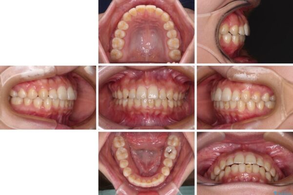 前歯のクロスバイト　目立たないワイヤー装置で速やかに矯正治療 治療途中画像