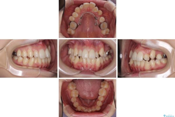 補助装置を併用したインビザラインでの八重歯の抜歯矯正 治療途中画像