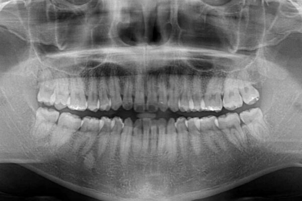 インビザラインで奥歯の咬み合わせと前歯のデコボコを改善 治療前画像