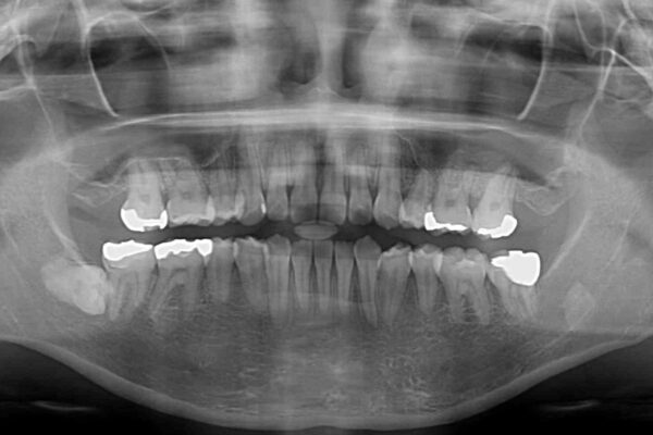 八重歯と前歯の欠損と骨格のズレ　目立たないワイヤー矯正 治療後画像