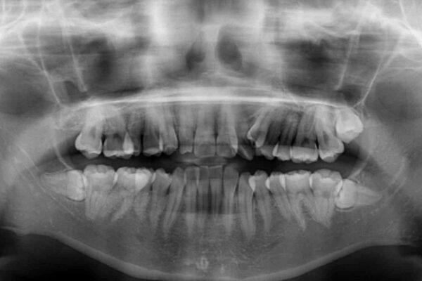 補助装置を併用したインビザラインでの八重歯の抜歯矯正 治療前画像