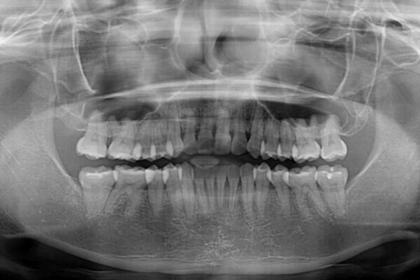 ワイヤー矯正で楽して治療　前歯のデコボコを短期間で改善 治療後画像
