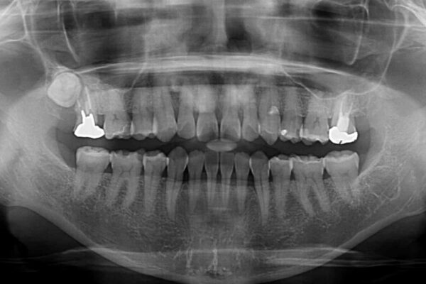 抜歯矯正の後戻りをインビザライン・ライトで解消 治療前画像