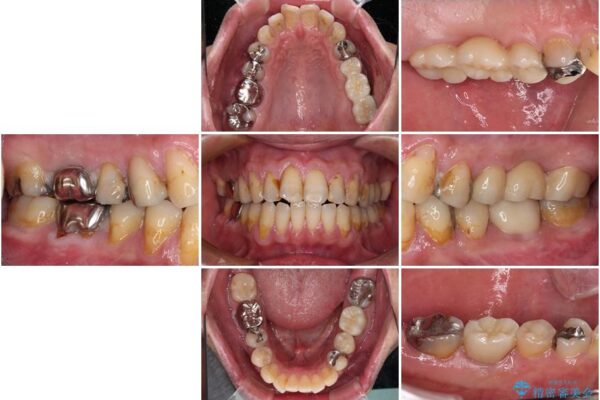 欠損と痛み　奥歯のむし歯治療 治療後画像