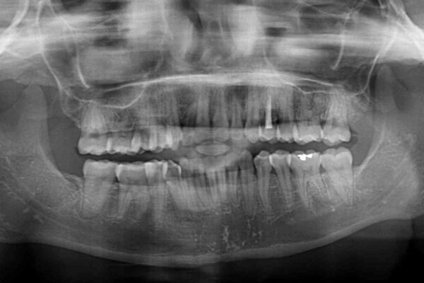前歯のクロスバイト　目立たないワイヤー装置で速やかに矯正治療 治療後画像