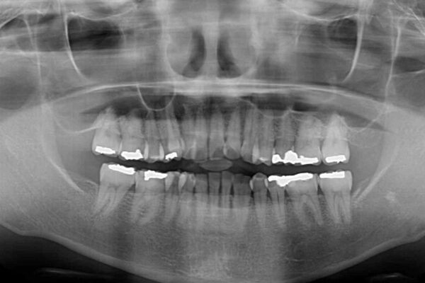 八重歯と形の悪い前歯　矯正治療とセラミック治療 治療前画像