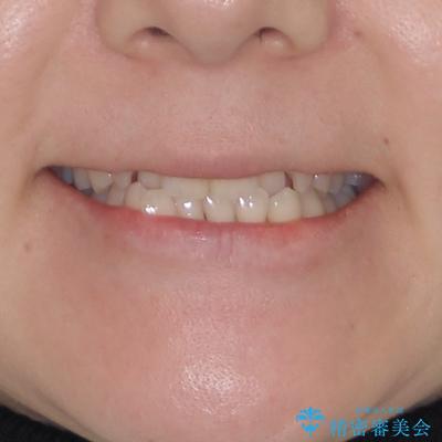 ワイヤー矯正で楽して治療　前歯のデコボコを短期間で改善 治療前画像