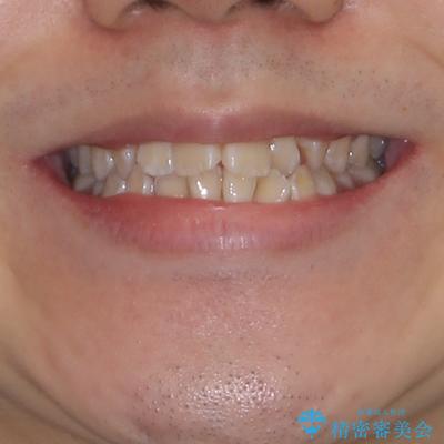 非抜歯ワイヤー装置による、短期間での矯正治療 治療前画像
