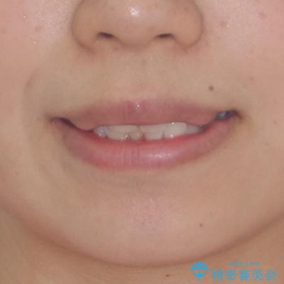 骨格的なズレをカムフラージュ　抜歯矯正で咬み合わせを改善 治療前画像