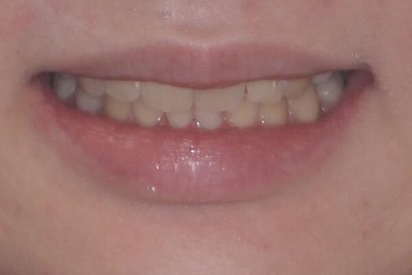 著しい八重歯を短期間で改善　ワイヤー装置による抜歯矯正 治療後画像