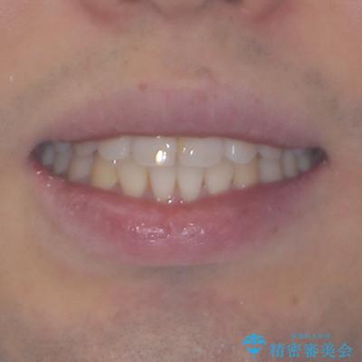 インビザラインで奥歯の咬み合わせと前歯のデコボコを改善 治療後画像