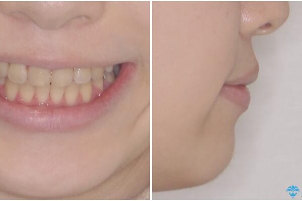 上下の出っ歯を治したい　ワイヤー装置による抜歯矯正 アフター