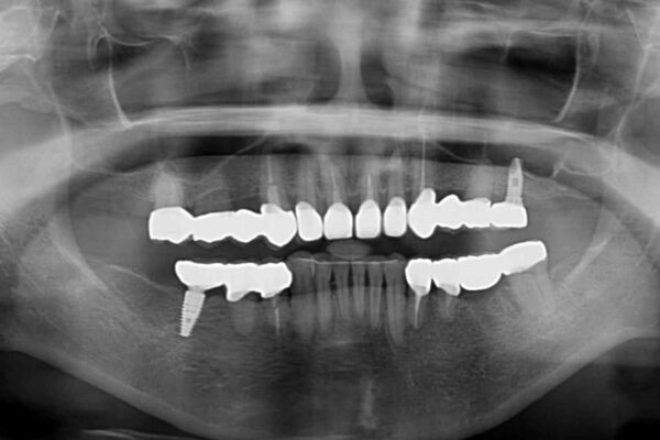 銀歯や入れ歯で汚い歯をきれいにしたい　総合歯科治療 治療後画像