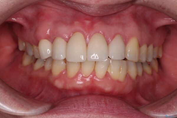 八重歯と形の悪い前歯　矯正治療とセラミック治療 治療後画像