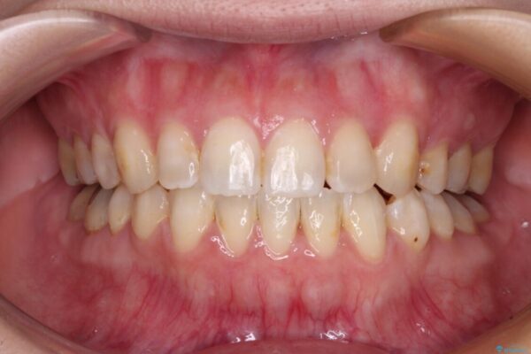 八重歯と前歯の欠損と骨格のズレ　目立たないワイヤー矯正 アフター