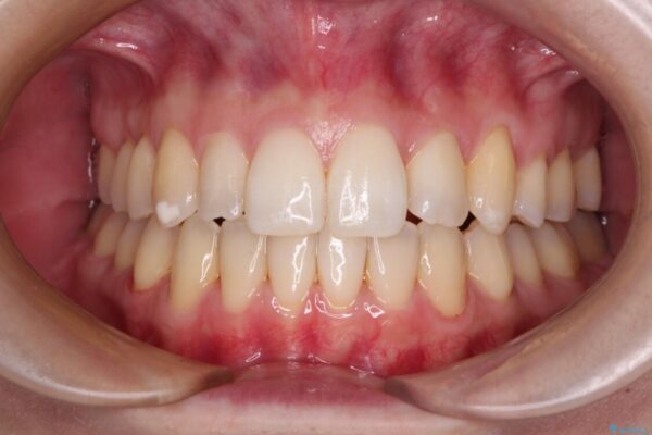 補助装置を併用したインビザラインでの八重歯の抜歯矯正 アフター