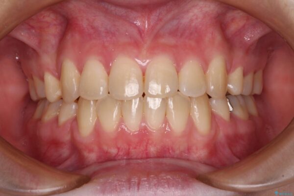 上下の出っ歯を治したい　ワイヤー装置による抜歯矯正 治療後画像