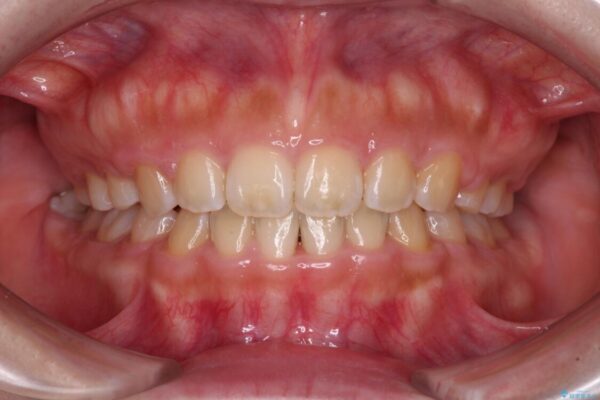 口元を引っ込めたい　目立たないワイヤー装置での抜歯矯正 治療後画像